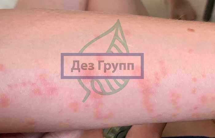 Аллергия на укус гнуса